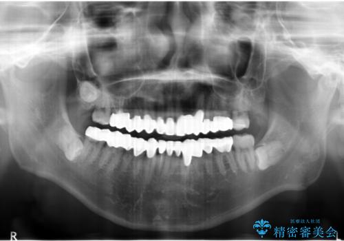 歯並びをきれいにしたい、歯を真っ白にしたい 40代男性の治療後