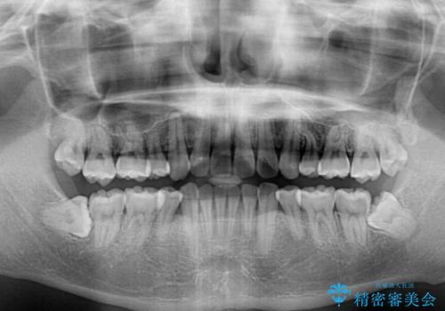 口元の突出感と叢生　ワイヤー装置による抜歯矯正の治療後