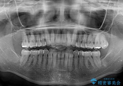 前歯の叢生と切端咬合　インビザラインによる矯正治療の治療後