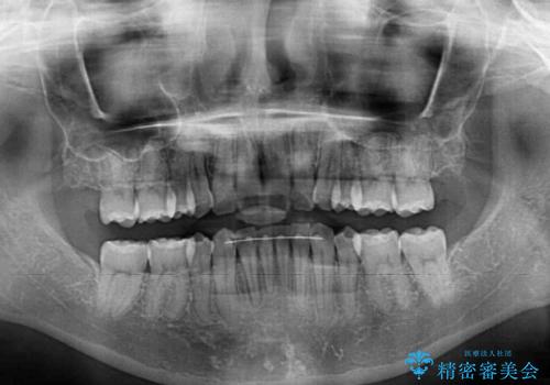 抜歯矯正の後戻り インビザラインによる再矯正治療の治療後