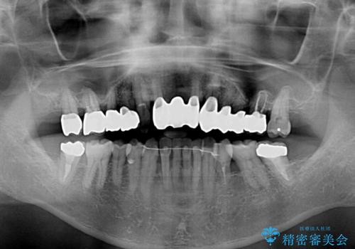 矯正治療と歯周外科処置を併用した審美歯科治療の治療後