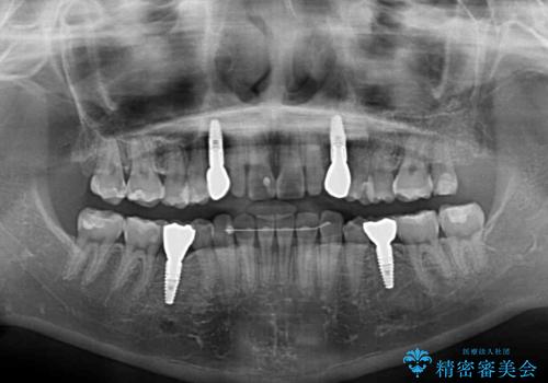 欠損と残存乳歯 矯正治療とインプラント治療の治療後