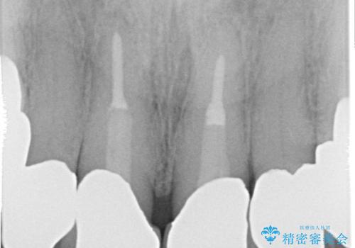 奥歯がなくてかめない 入れ歯とクラウンでの全顎治療の治療後