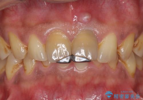 歯ぐきからの出血 膿が出る 前歯根管・セラミック治療の治療前