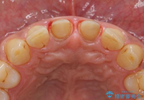 歯ぐきからの出血 膿が出る 前歯根管・セラミック治療の治療中