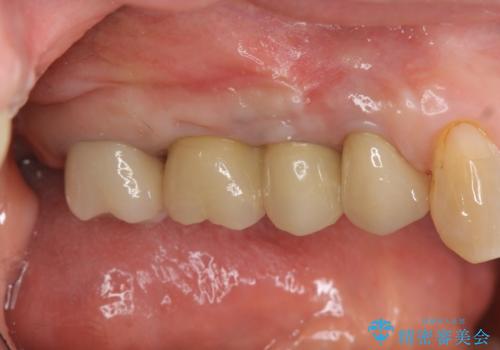 [ 歯牙破折 ]  インプラントによる咬合機能回復の症例 治療後