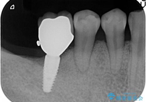 奥歯が痛い。抜歯～奥歯のインプラント　の治療後