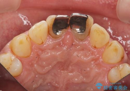 歯ぐきからの出血 膿が出る 前歯根管・セラミック治療の治療前
