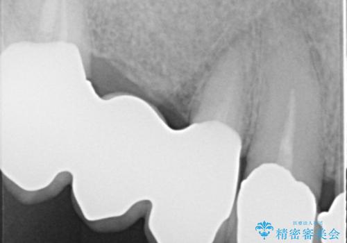 奥歯がなくてかめない 入れ歯とクラウンでの全顎治療の治療後