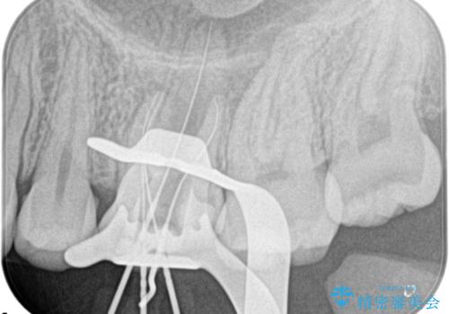 奥歯の根管治療の治療中