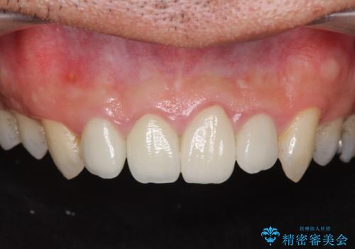 [根管治療・セラミック補綴]  歯ぐきを押すと痛いの症例 治療前