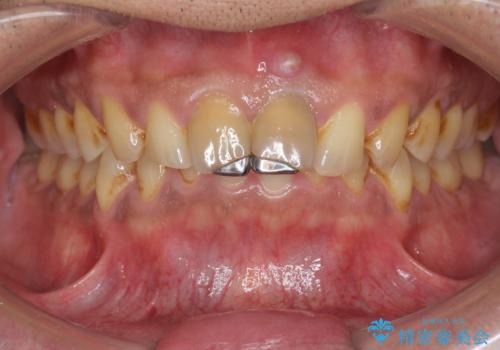 歯ぐきからの出血 膿が出る 前歯根管・セラミック治療の治療前