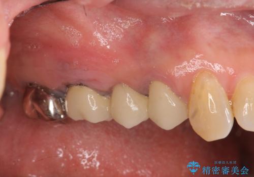 [ 歯牙破折 ]  インプラントによる咬合機能回復の症例 治療前