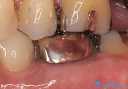 オールセラミッククラウン 銀歯を白くの治療前