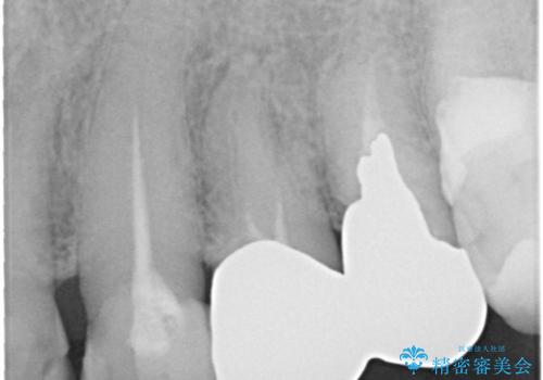 奥歯がなくてかめない 入れ歯とクラウンでの全顎治療の治療前