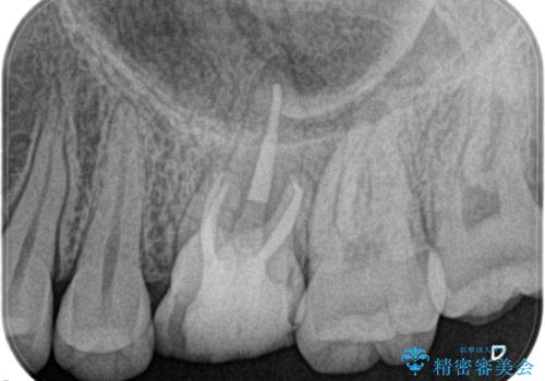 奥歯の根管治療の症例 治療後