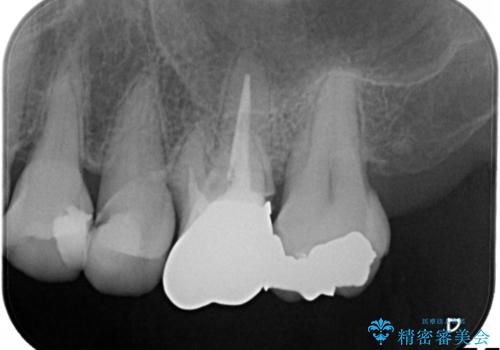 発見の難しい虫歯。根管治療から被せもの治療の治療前