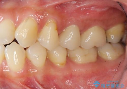 放置し崩壊した歯 セラミック治療による咬合機能回復の治療後