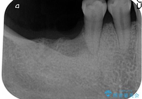 奥歯が痛い。抜歯~奥歯のインプラント の治療中