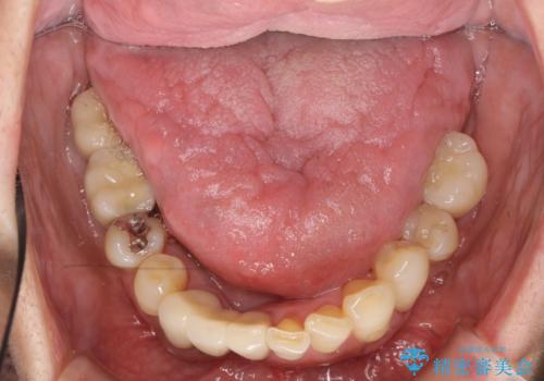 歯周病 インプラントによる咬合機能回復の治療後