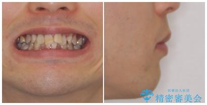口元の突出感と叢生　ワイヤー装置による抜歯矯正の治療前（顔貌）