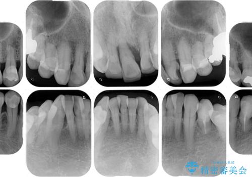 矯正治療と歯周外科処置を併用した審美歯科治療の治療前