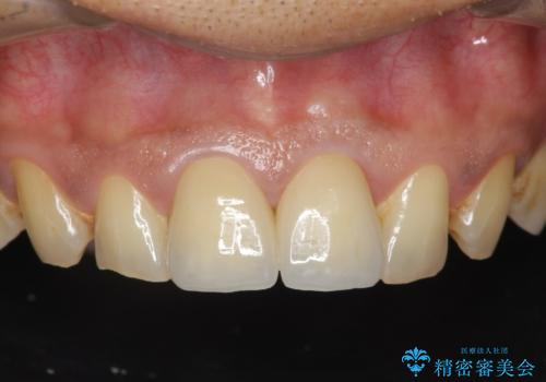 歯ぐきからの出血　膿が出る 前歯根管・セラミック治療の症例 治療後