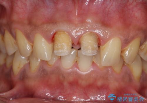 歯ぐきからの出血 膿が出る 前歯根管・セラミック治療の治療中