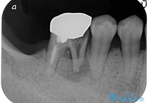 奥歯が痛い。抜歯~奥歯のインプラント の治療前