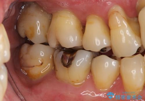 歯周病 インプラントによる咬合機能回復の治療前
