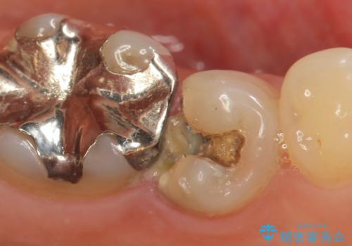 銀歯が外れ、内部に大きな虫歯の再発の症例 治療前