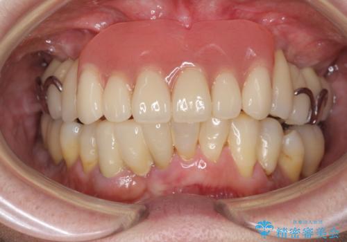 歯周病 インプラントによる咬合機能回復の症例 治療後