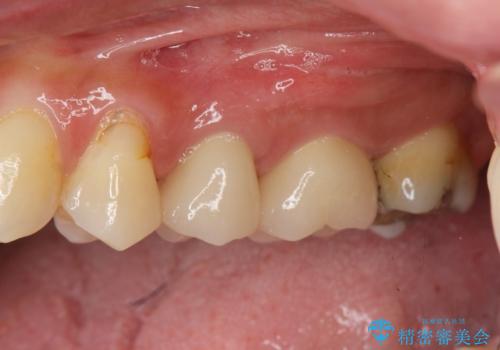 放置し崩壊した歯 セラミック治療による咬合機能回復の治療後