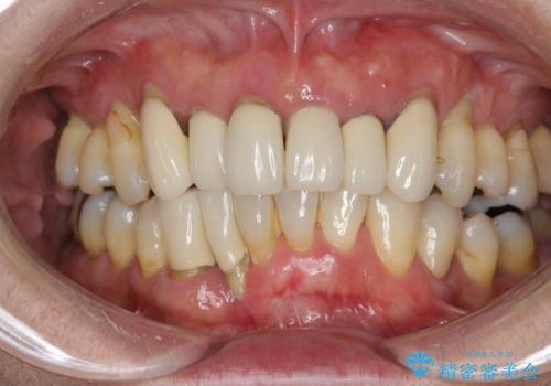 歯周病 インプラントによる咬合機能回復の症例 治療前