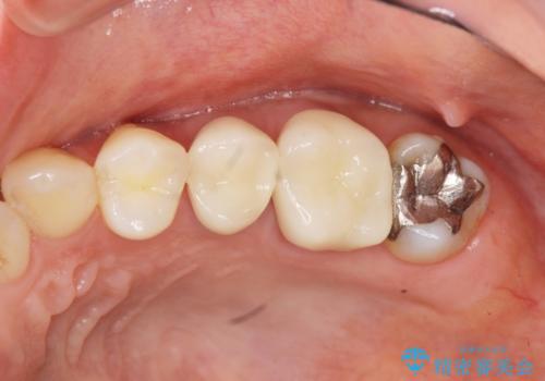 放置し崩壊した歯　セラミック治療による咬合機能回復の症例 治療後