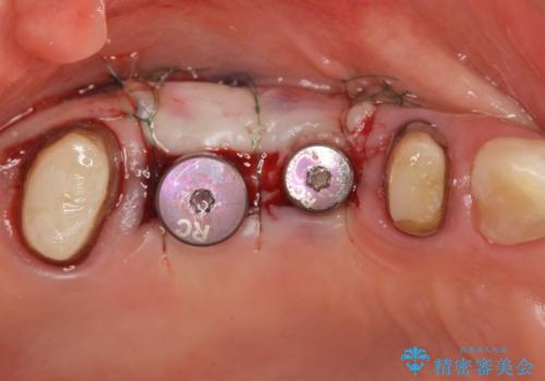 [ 歯牙破折 ]  インプラントによる咬合機能回復の治療中
