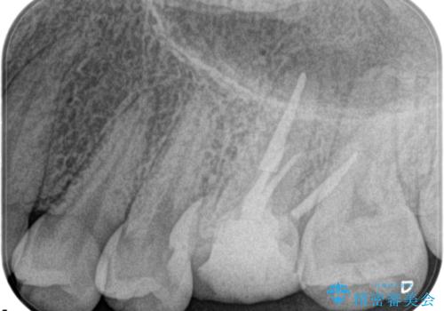 奥歯の根管治療の治療後