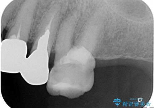 奥歯がなくてかめない 入れ歯とクラウンでの全顎治療の治療前