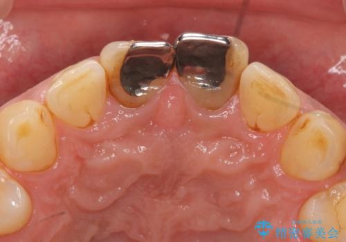 歯ぐきからの出血 膿が出る 前歯根管・セラミック治療の治療前