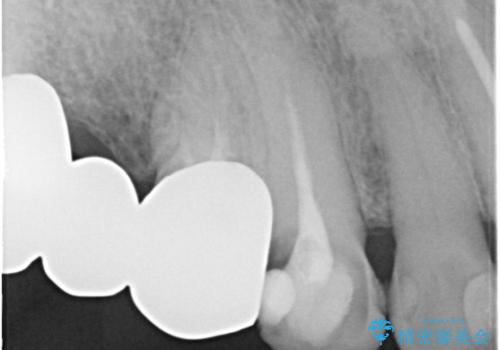 奥歯がなくてかめない 入れ歯とクラウンでの全顎治療の治療前