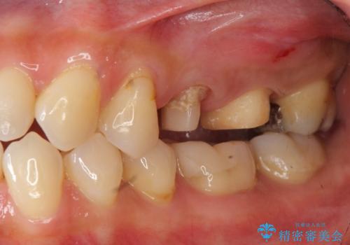 放置し崩壊した歯 セラミック治療による咬合機能回復の治療中