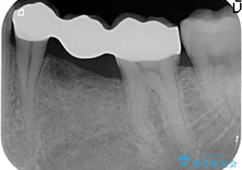 奥歯が痛い。乳歯を抜歯し、ブリッジによる咬合回復。の治療後