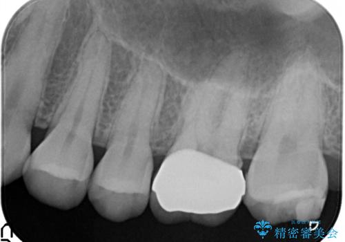 【メタルフリー】銀歯を白くしたい。オールセラミッククラウン。の治療後