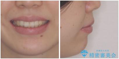 インプラント治療とインビザライン矯正治療 総合歯科治療の治療後(顔貌)