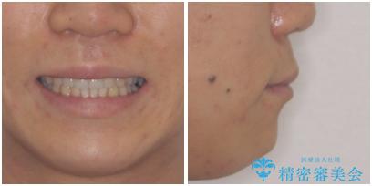 口が少し閉じにくい インビザラインによる非抜歯矯正の治療後(顔貌)