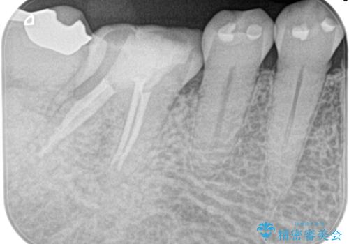 奥歯が痛い。精密根管治療〜オールセラミッククラウンの治療後