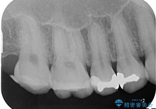 【メタルフリー】銀歯を白くしたい。オールセラミッククラウン。の治療前