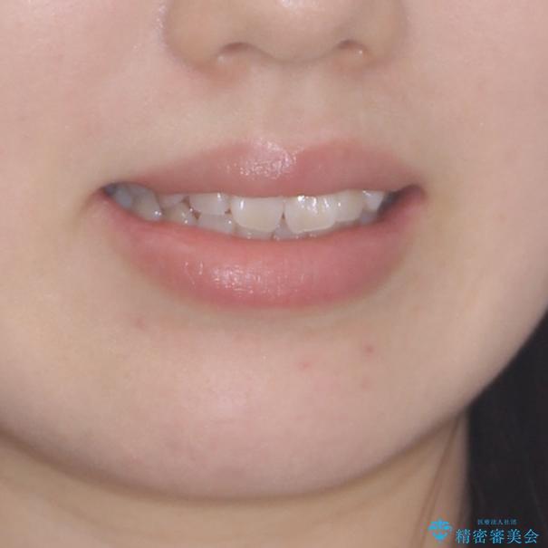 気になる前歯をインビザラインで綺麗にの治療前(顔貌)