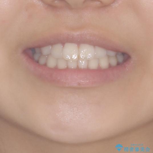 気になる前歯を整えたい　インビザライン・ライトでの矯正治療の治療前（顔貌）