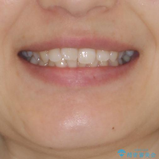 奥歯の倒れた歯を改善　インビザラインでの矯正治療の治療前（顔貌）